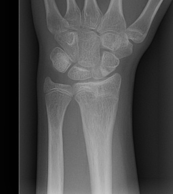 Distal Radius Growth Arrest